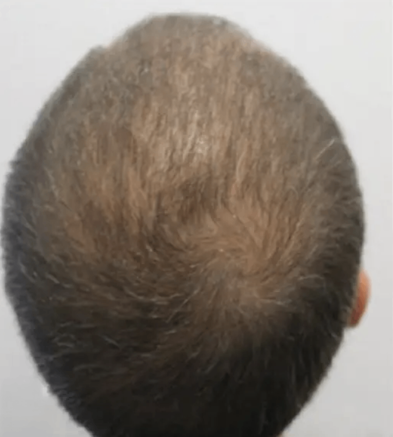 Tratamiento profesional para alopecia y regeneración capilar